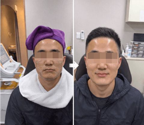 울쎄라 300샷, 효과는 샷 수에 비례하지 않습니다