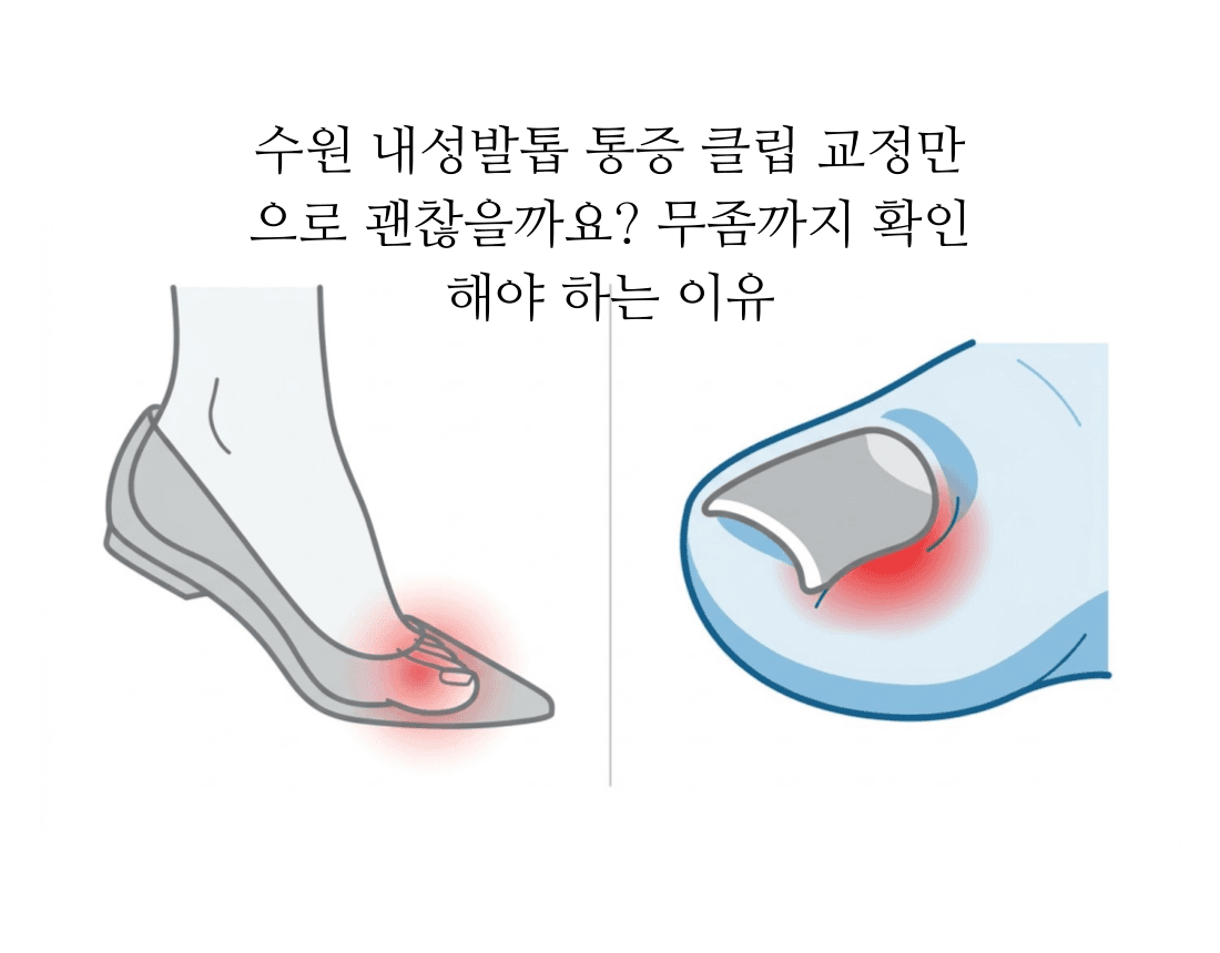 내성발톱은 뽑기 전에 무좀부터 확인합니다