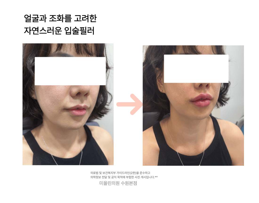 입술필러는 몇 cc가 아니라 어디에 넣느냐가 인상을 만듭니다